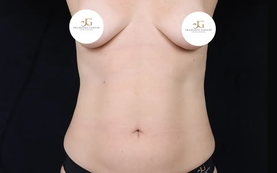 Antes da lipoabdominoplastia, paciente de frente, sem o rosto