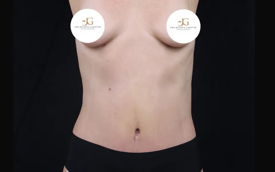 Depois da lipoabdominoplastia, paciente de frente, sem o rosto