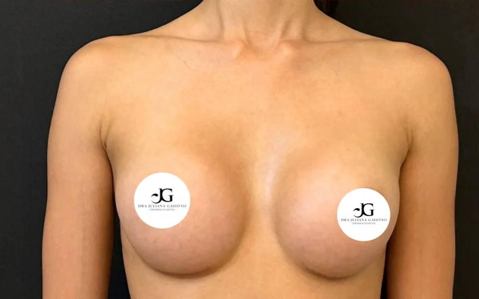 Depois da prótese de silicone, paciente de frente, sem o rosto